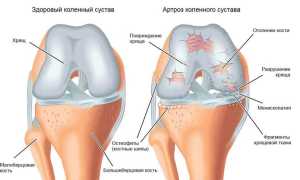 Что делать, если хрустят колени при сгибании