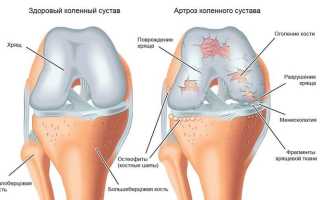 Что делать, если хрустят колени при сгибании