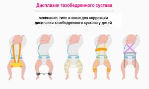 Как вылечить вывих тазобедренного сустава у новорожденных детей