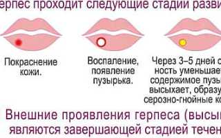 Герпес на губах — как вылечить быстро