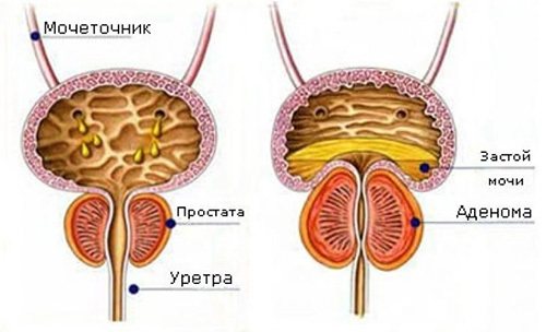 Две струи при мочеиспускании у мужчин и струя раздваивается: причины и лечение