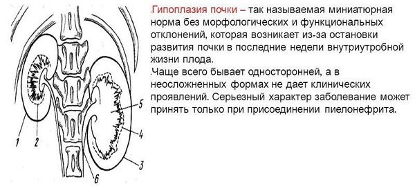 Гипоплазия почки (правой и левой): признаки, симптомы и лечение
