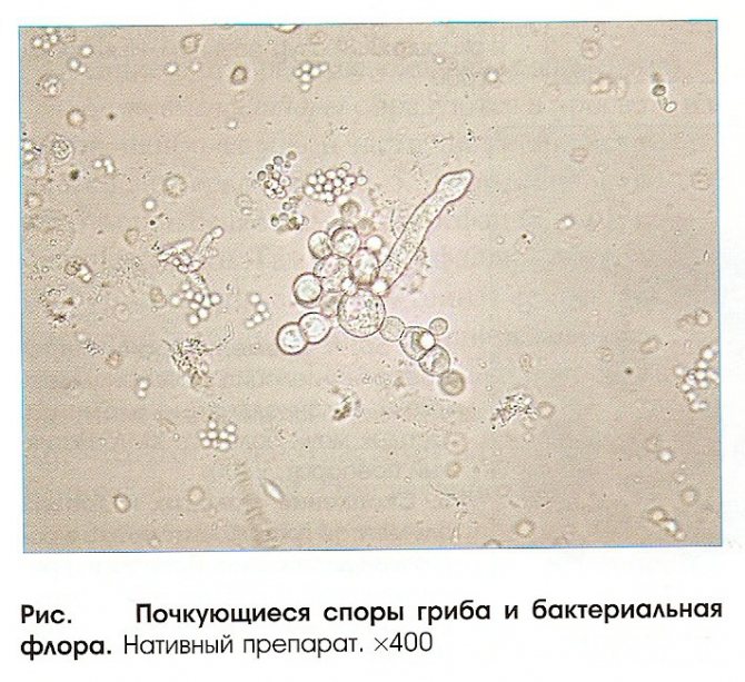 Грибок в анализе мочи