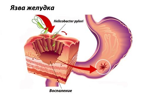Каллезная язва