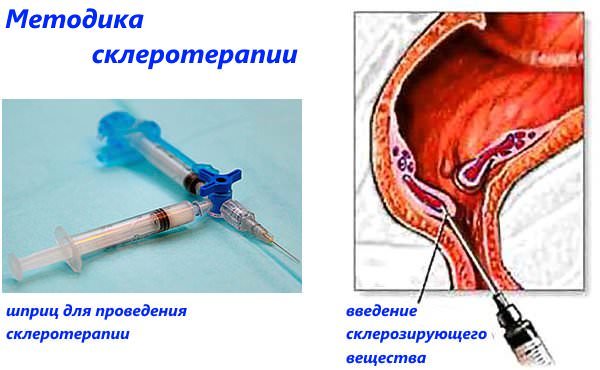 методика склеротерапии
