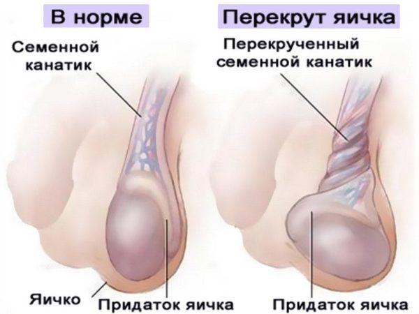 Перекрут яичка