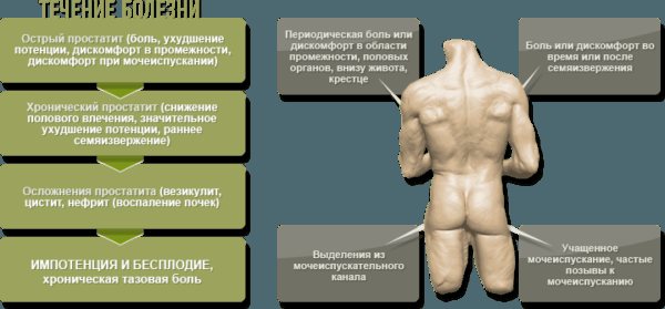 Симптомы простатита