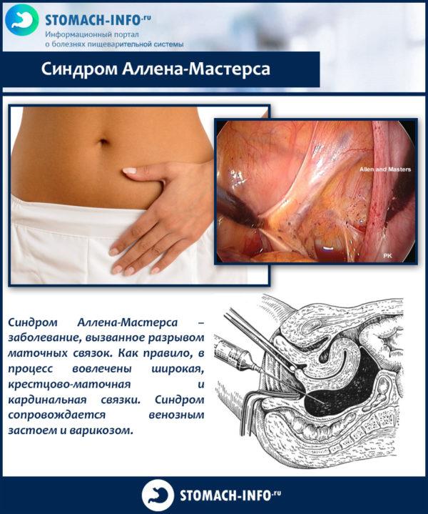 Синдром Аллена-Мастерса