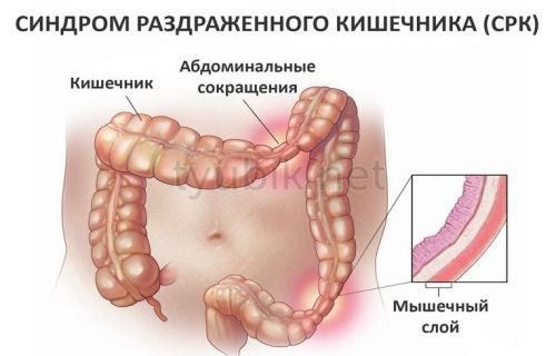 Синдром раздраженного кишечника