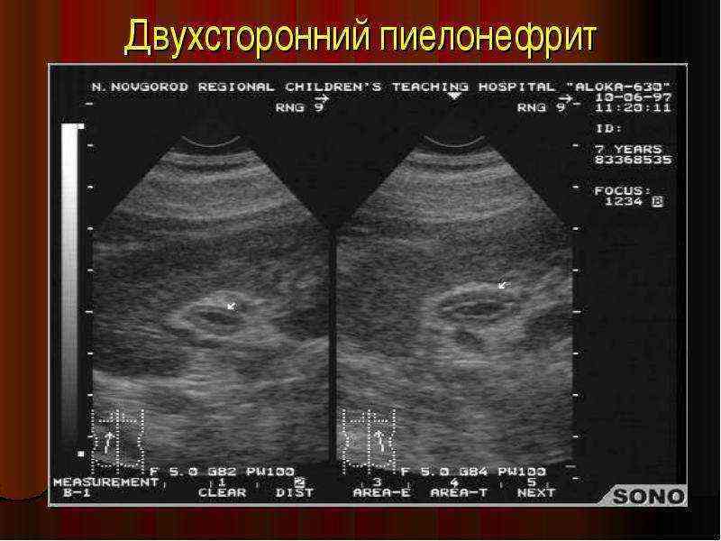 узи признаки пиелонефрита