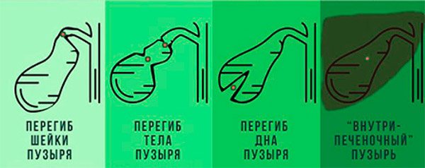 виды перегиба желчного