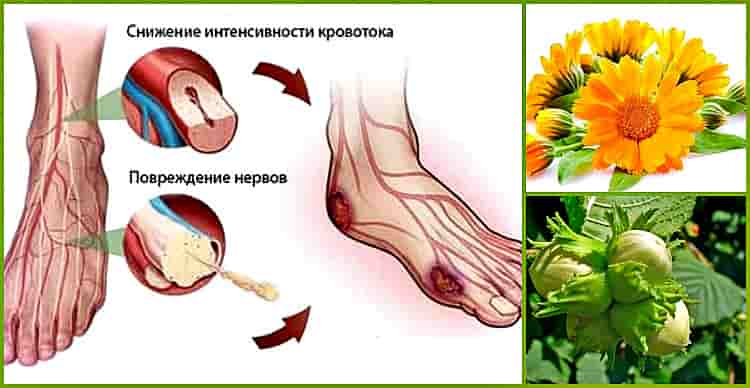 лечение народными средствами