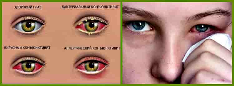виды заболевания