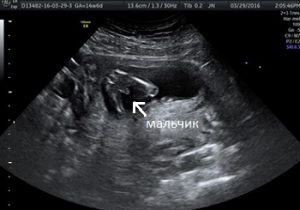 Мальчик на 2d УЗИ