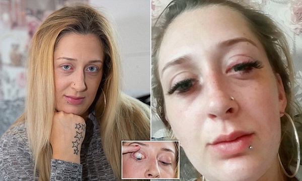 Стейси Луиз Болл с аллергией после наращивания ресниц