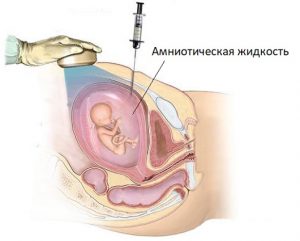 Амниоцентез