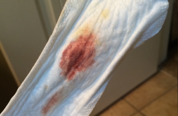 Кровотечение при имплантации на прокладке