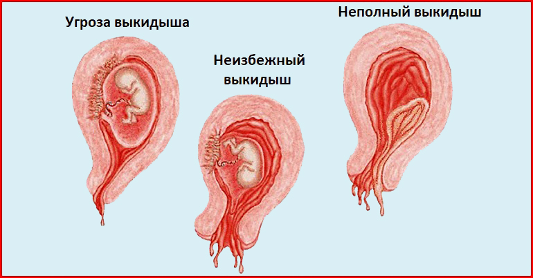 Неполный выкидыш