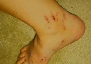 Расчесы на ногах при акушерском холестазе