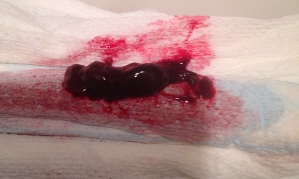 Сгустки крови при выкидыше