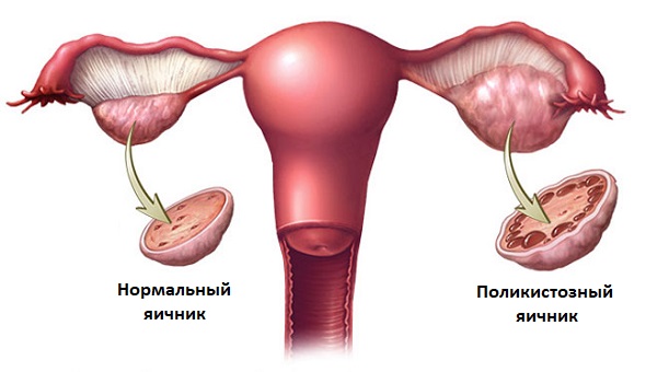 Яичник при СПКЯ